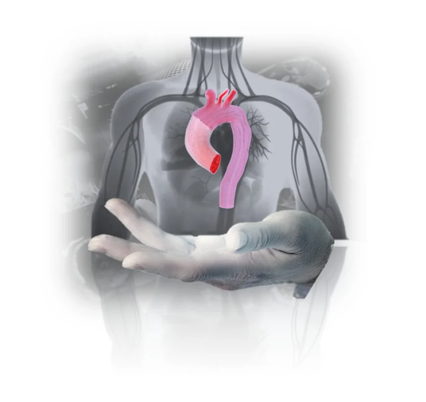 Aneurismi aortici: il progetto europeo Pandora rivoluziona la chirurgia con la modellazione in-silico