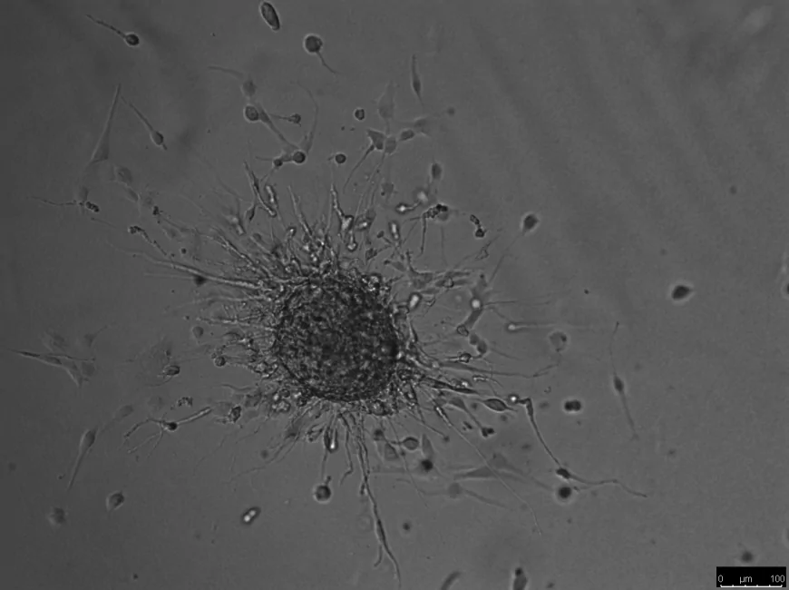 Nuove speranze contro il tumore al cervello: il cocktail genetico progettato dai ricercatori dell’Istituto Italiano di Tecnologia per indebolire il glioblastoma