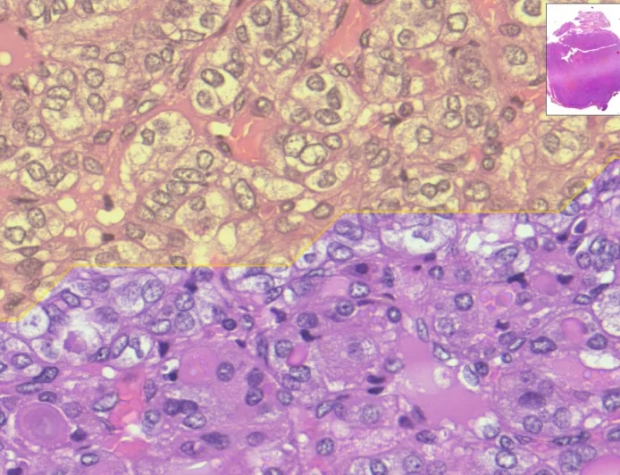 Nasce MiThyCA, un sistema di Intelligenza Artificiale che aiuta a leggere le immagini digitali dei vetrini istologici della tiroide
