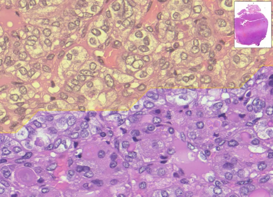 Nasce MiThyCA, un sistema di Intelligenza Artificiale che aiuta a leggere le immagini digitali dei vetrini istologici della tiroide