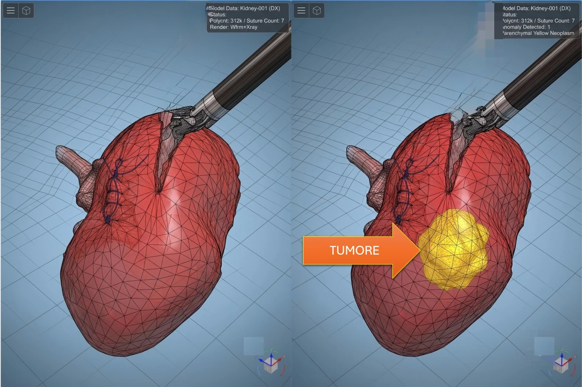 Tumore al rene: modelli biometrici su pazienti reali per una chirurgia robotica sempre più precisa
