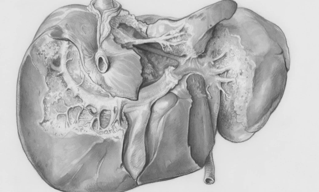 Malattie autoimmuni del fegato: definiti per la prima volta i criteri condivisi per riconoscere e trattare la sindrome variante PBC-AIH