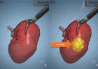 Tumore al rene: modelli biometrici su pazienti reali per una chirurgia robotica sempre più precisa