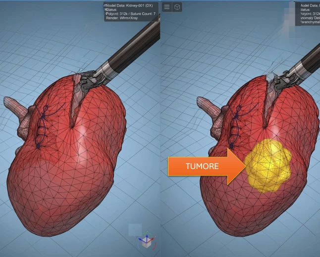 Tumore al rene: modelli biometrici su pazienti reali per una chirurgia robotica sempre più precisa