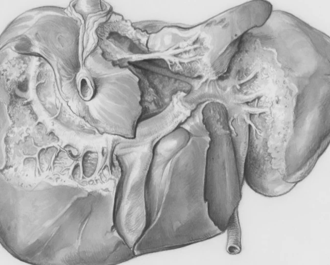 Malattie autoimmuni del fegato: definiti per la prima volta i criteri condivisi per riconoscere e trattare la sindrome variante PBC-AIH