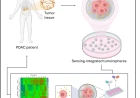 Tumore del pancreas: sensori "intelligenti" nei tessuti misurano la risposta alla chemioterapia